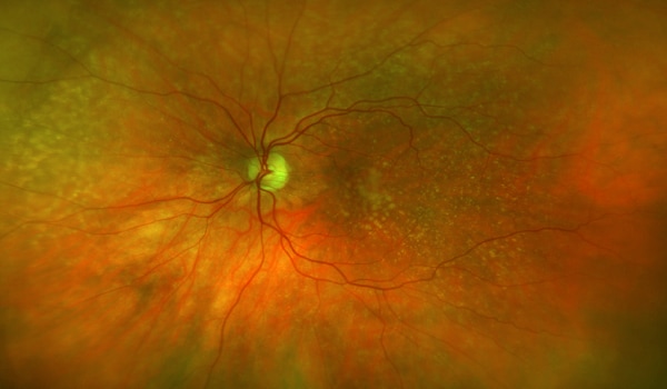 Neovasculaire LMD Neovasculaire LMD